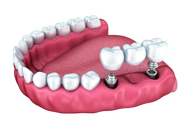 3 Sobre 6 Implantes Dentales en Turquía