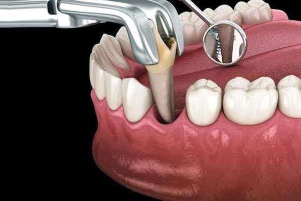 Extracción Dental en Turquía: La Solución Segura y Efectiva para Tus Problemas Dentales