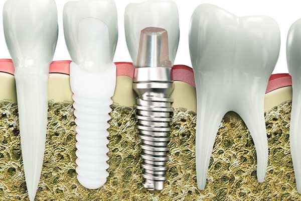 Implantes de Circonio en Turquía