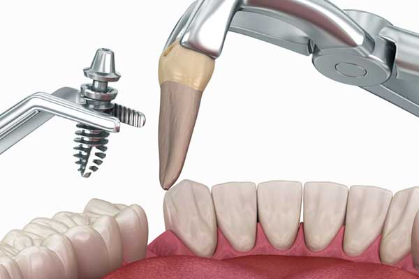 Implantes Inmediatos en Turquía