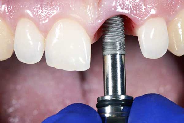 Implantes Dentales en Turquía