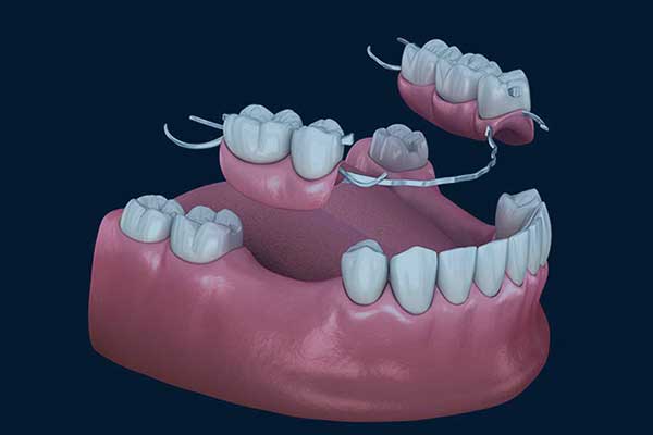 Puentes Dentales en Turquía