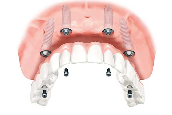 Todo en 4 Implantes Dentales en Turquía