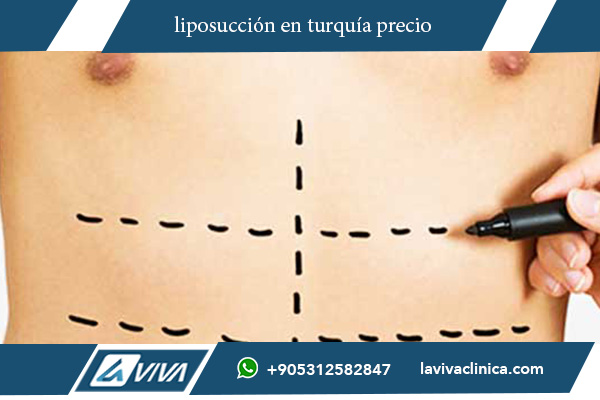 abdominoplastia en turquía precio