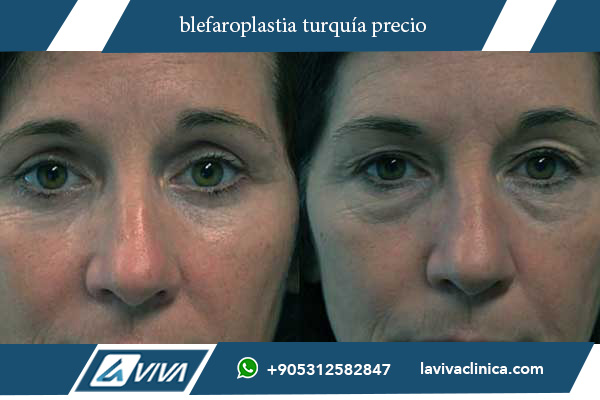 blefaroplastia en turquía opiniones