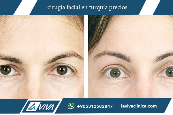 cuanto cuesta una cirugía facial en turquía