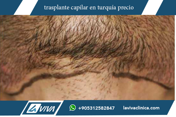 implante de pelo en turquía