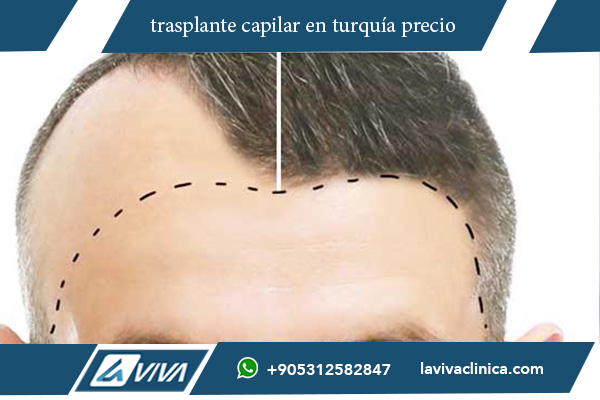 implante de pelo turquia