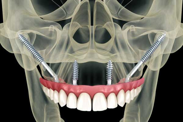 Implantes Cigomáticos en Turquía