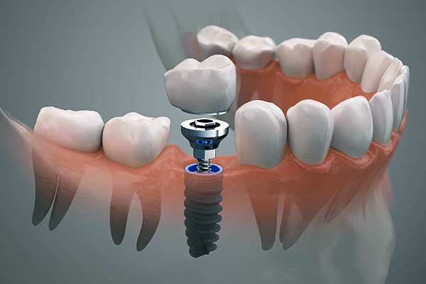 Implantes Dentales de Boca Completa en Turquía