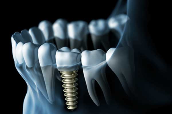 implantes dentales en estambul