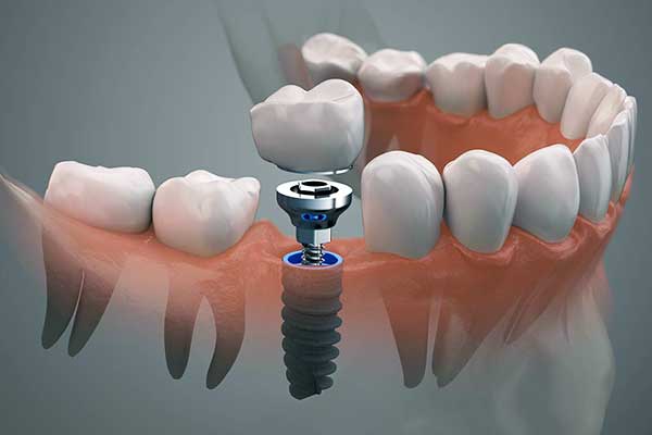 implantes dentales en turquía opiniones