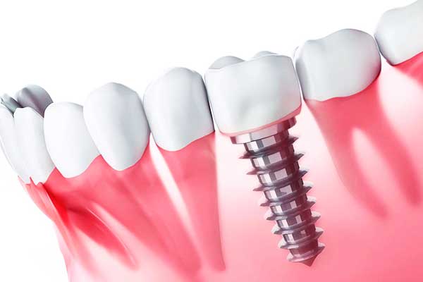 implantes dentales en turquía precios