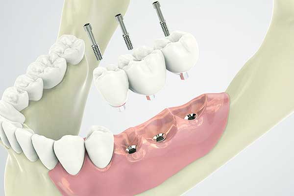 implantes dentales estambul