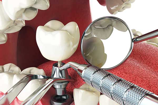 implantes dentales turquia