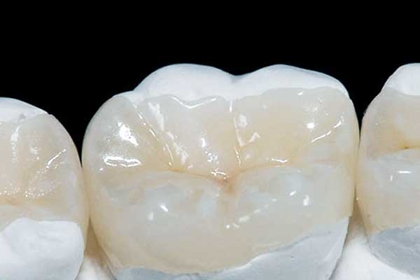 Incrustación Dental en Turquía