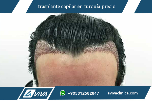 injerto pelo turquia