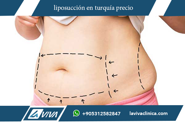 liposucción en turquía