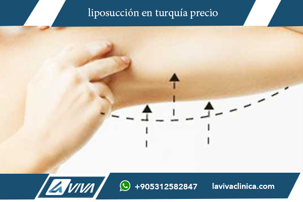 liposucción turquía precio