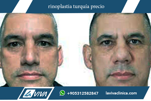 operacion nariz turquia precio