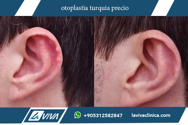 otoplastia en turquía