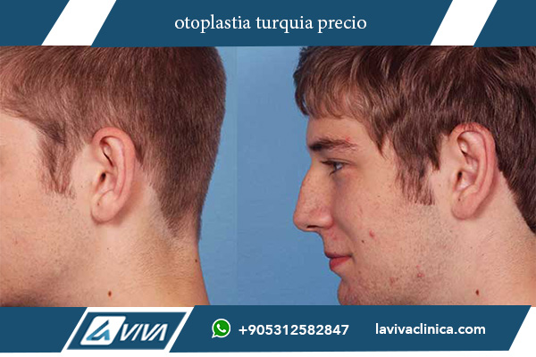 otoplastia turquia precio