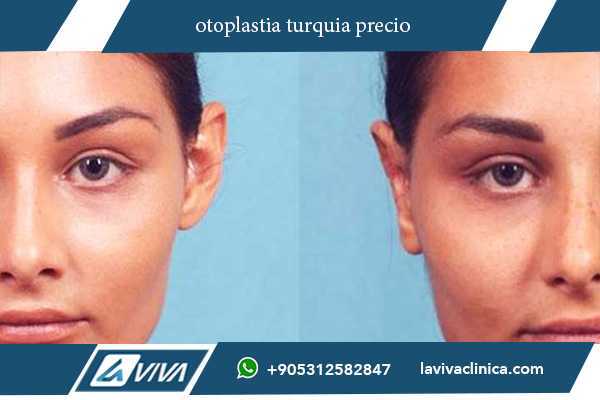 otoplastia turquia