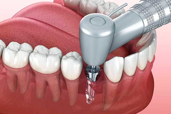 poner implantes dentales en turquía precios