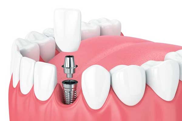 precio implantes dentales en estambul