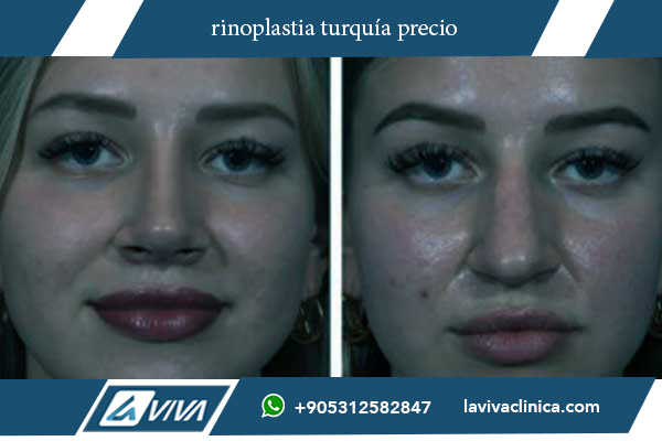 precio rinoplastia turquia