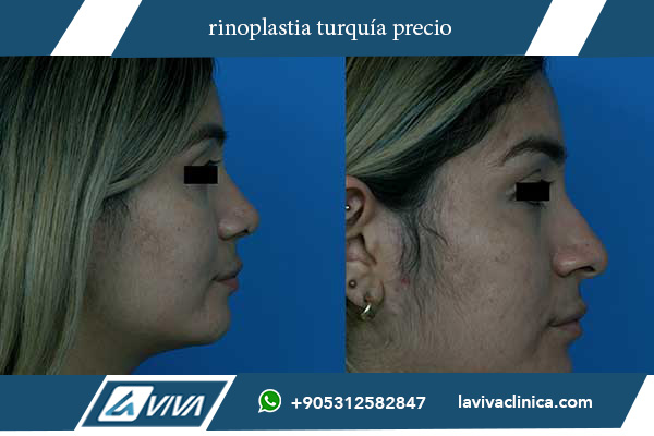 rinoplastia en estambul precio