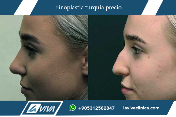 rinoplastia en turquía opiniones