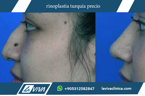 rinoplastia en turquia