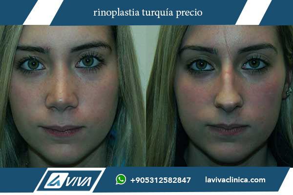 rinoplastia estambul