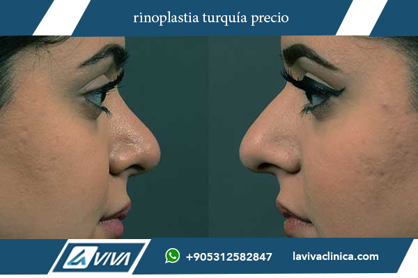 rinoplastia na turquia valor