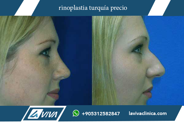 rinoplastia precio turquía