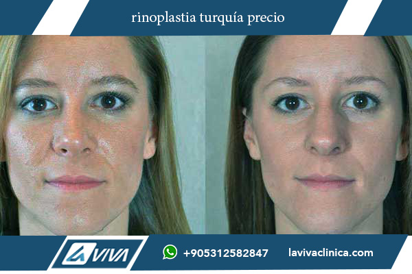 rinoplastia turquía precio