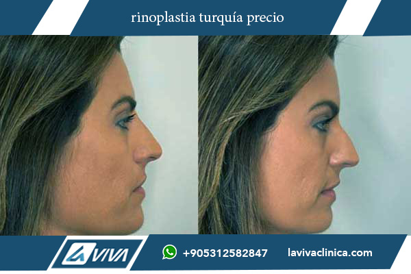 rinoplastia turquía todo incluido