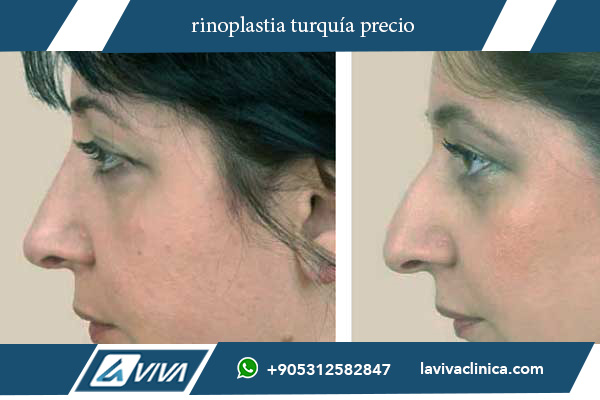 rinoplastia ultrasonica turquia