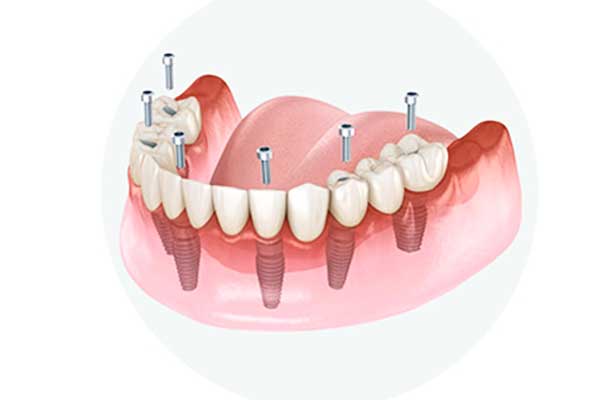 turquía implantes dentales precio