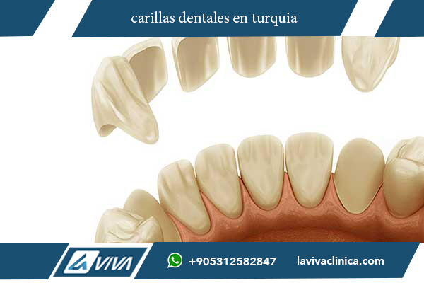 carillas dentales en turquia