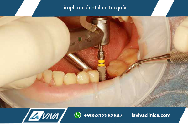 implante dental en turquía