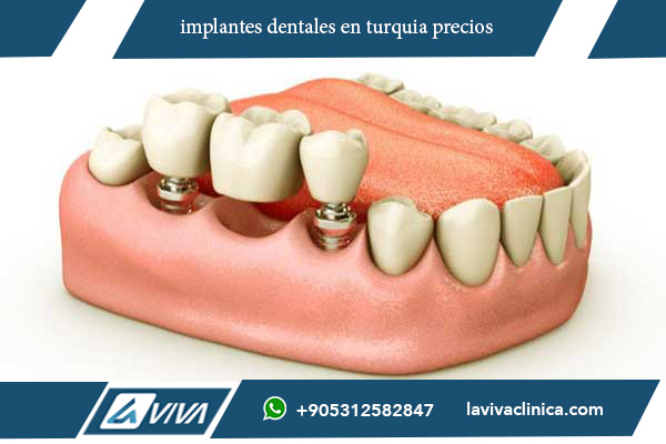 implantes dentales en turquia precios