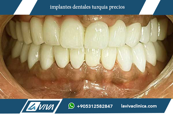 implantes dentales turquia precios