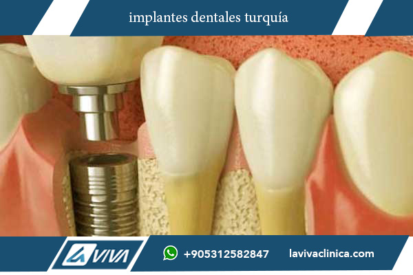 implantes dentales turquía