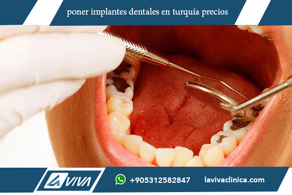 poner implantes dentales en turquía precios