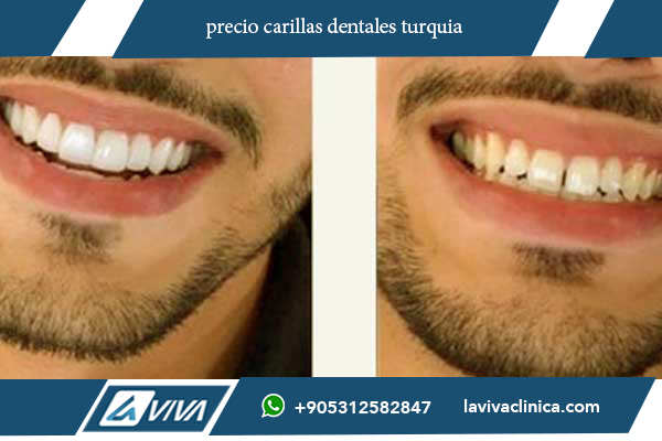 precio carillas dentales turquia