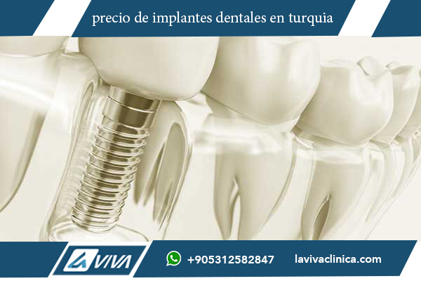 precio de implantes dentales en turquia