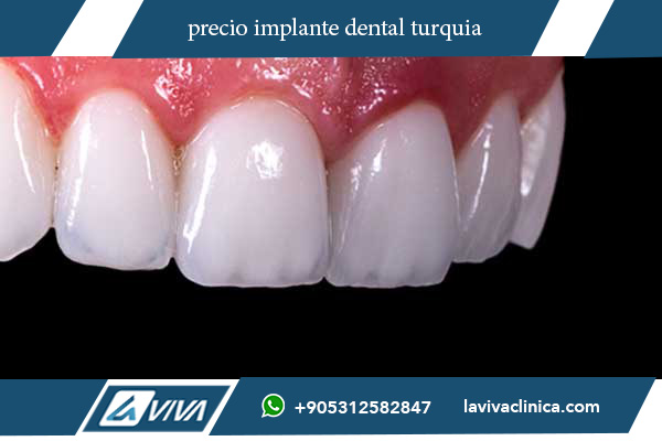 precio implante dental turquia