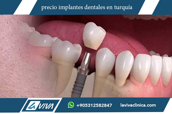 precio implantes dentales en turquía